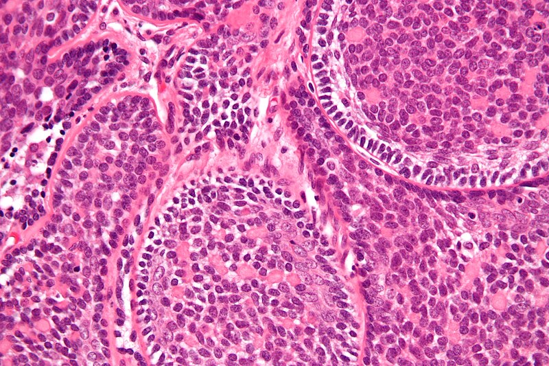 File:Basal cell adenocarcinoma - 2 - parotid gland - very high mag.jpg