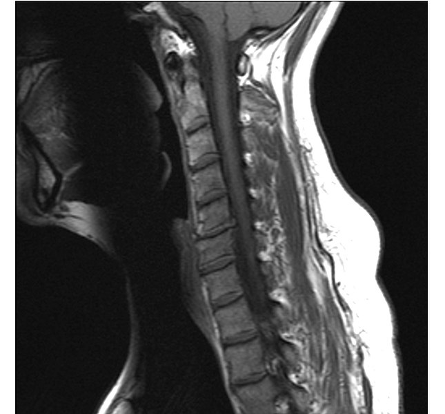 File:Cervical Spine MRI showing disc herniation.jpg