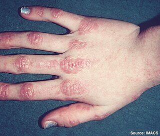 Dermatomyositis myositis that results in inflammation located in muscle or located in skin where a skin rash is often seen prior to the onset of muscle weakness