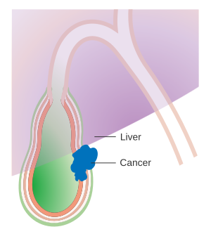 Diagram showing stage T3 gallbladder cancer CRUK 436.svg