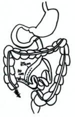 The surgical procedure of end-to-side jejunoileal bypass ES JI bypass.png