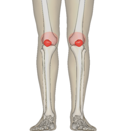 Diagram of the bones of the lower extremity. Rough distribution of areas affected by PFPS highlighted in red: patella and distal femur.