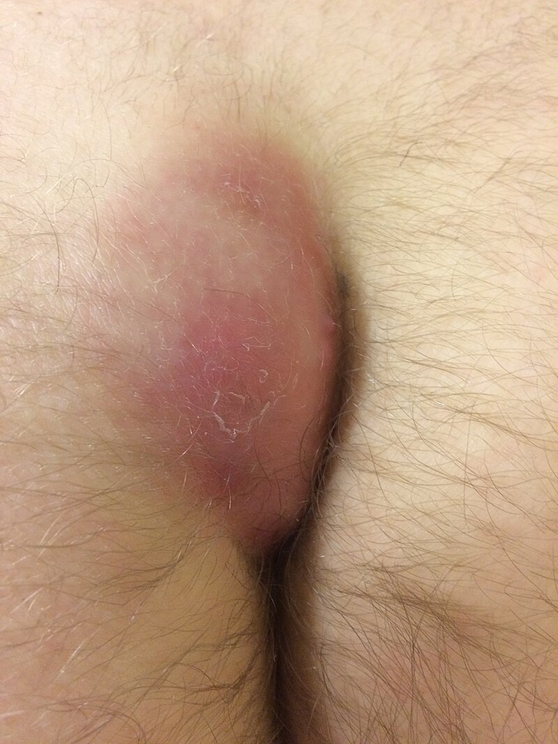 why does my pilonidal cyst look like scab that never heals : r/pilonidalcyst
