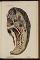 Plate VI; Tuberculosis, lung with abscesses & gangrene 1834 Wellcome L0074279.jpg