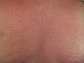 Rash on the chest of a person with anaphylaxis.jpg