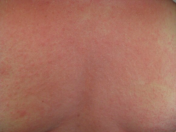 Urticaria and flushing on the back of a person with anaphylaxis