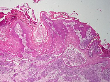 Follicular infundibulum tumor SkinTumors-P8250673.JPG