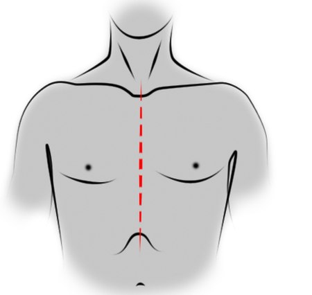 Sternotomie médiane.jpg