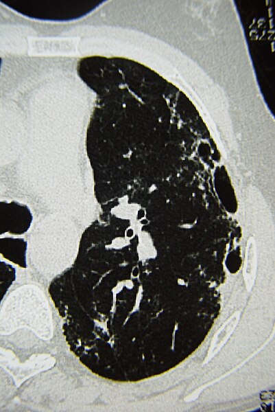 File:Systemic sclerosis case 32 pic 07.jpg