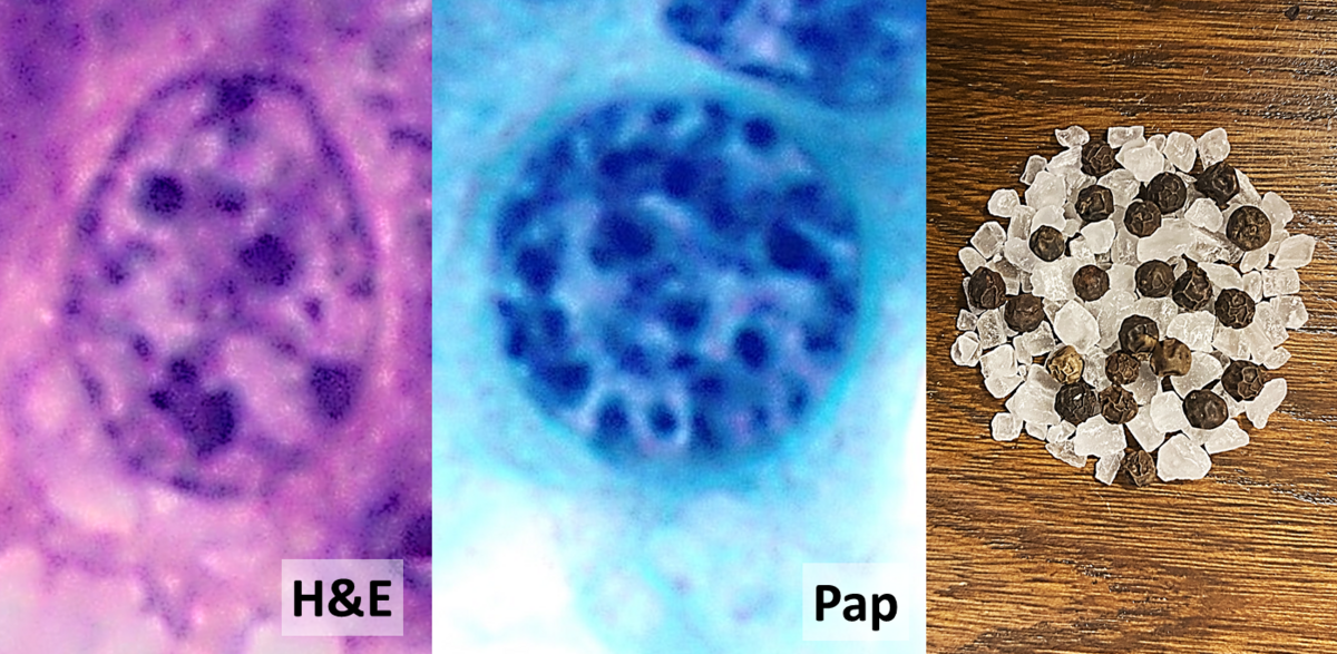 https://upload.wikimedia.org/wikipedia/commons/thumb/c/cc/Well-differentiated_neuroendocrine_tumor_with_salt-and-pepper_chromatin.png/1200px-Well-differentiated_neuroendocrine_tumor_with_salt-and-pepper_chromatin.png