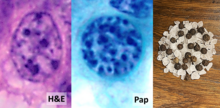 Granular "salt-and-pepper chromatin", seen on H&E, Pap stain and comparison to actual salt and pepper. Its finding on microscopy indicates mainly medullary thyroid carcinoma, neuroendocrine tumours or pheochromocytoma. Well-differentiated neuroendocrine tumor with salt-and-pepper chromatin.png