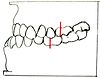 Angle classification: Class III Zahnfehlstellung Angle-Klasse III.jpg