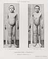 A young boy with stunted growth and swollen leg Wellcome L0034945.jpg