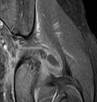 Coronal fat suppressed post contrast image showing a multiloculated bacterial abscess in the left gluteus minimus muscle due to tropical pyomyositis.