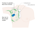 Stage 2B breast cancer