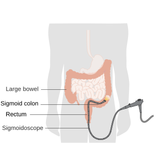 <span class="mw-page-title-main">Sigmoidoscopy</span> Medica examination of the large intestine from the rectum to the sigmoid colon