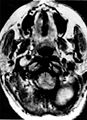 Ectopic functional paraganglioma (glomus jugulare) in a patient with VHL. T2 weighted MRI at the same location demonstrates a high signal mass consistent with a paraganglioma. Extra adrenal paragangliomas can be found in VHL (arrow).