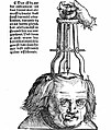 Trepanation, as described by Hans von Gersdorff in Feldbuch der Wundartzney (1517)