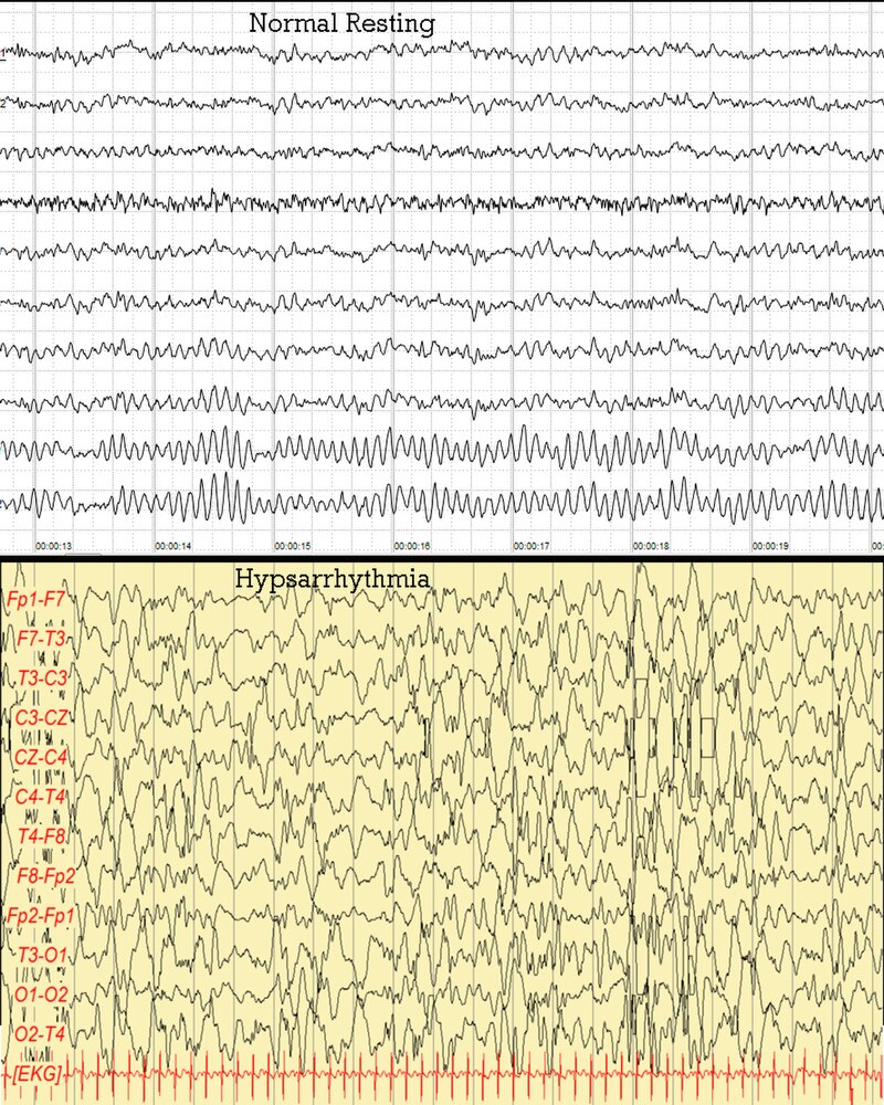 abnormal eeg