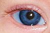 Color d'ulls en pacients amb albinisme oculacutani sever, violeta
