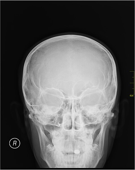 File:Medical X-Ray imaging PWH06 nevit.jpg