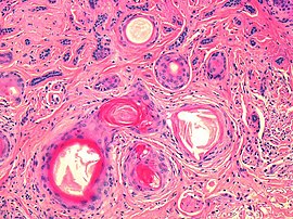 Mikrofotografie mikrocystického adnexálního karcinomu - povrchové folikulární cysty naplněné keratinem. Jpg