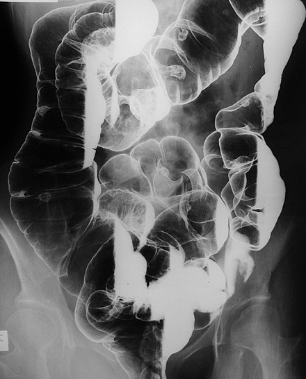 Barium enema radiograph showing multiple polyps (mostly pedunculated) and at least one large mass at the hepatic flexure coated with contrast in a patient with Peutz–Jeghers syndrome