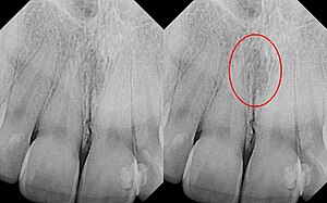 Nasolabial duct cyst.JPG