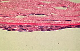 May 18: appearance of posterior polymorphous corneal dystrophy