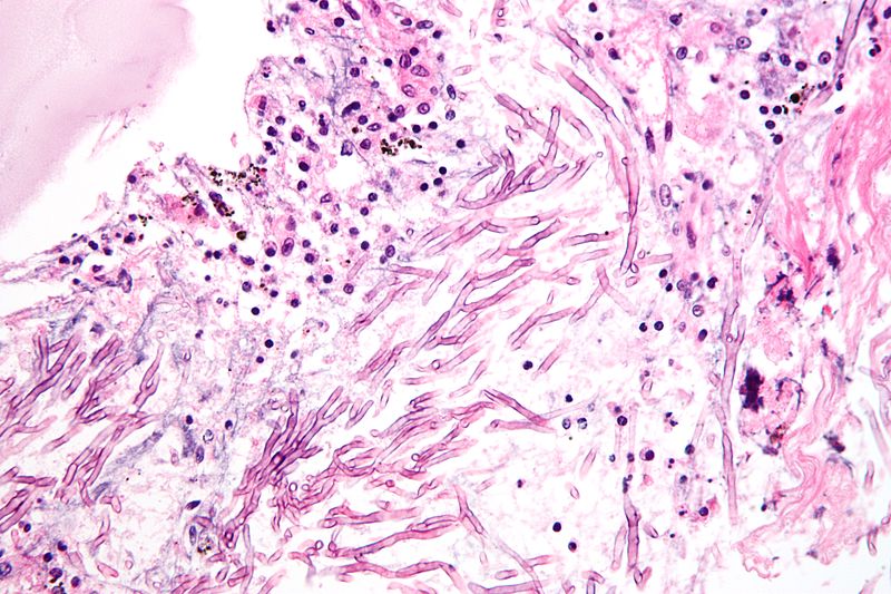 File:Pulmonary aspergillosis.jpg