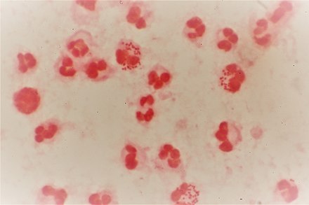 Gramme-stained pus from a urethral discharge showing Gramme-negative, intracellular diplococci