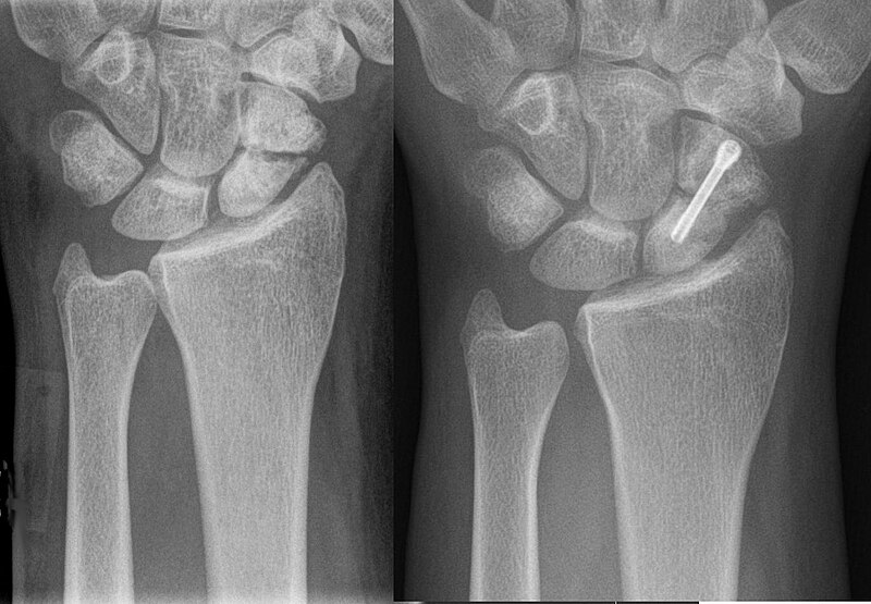 File:Scaphoid-Pseudarthrose1.jpg