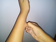Skin hyperelasticity in the wrist
