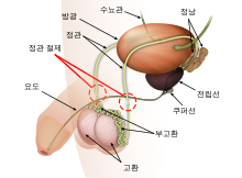 Vasectomy diagram-ko.svg