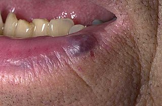 <span class="mw-page-title-main">Venous lake</span> Type of papule usually on the lip, face or ears and among the elderly