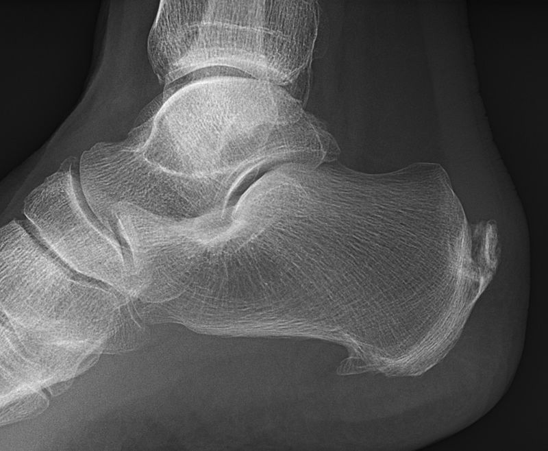 Anatomy of the plantar aspect of the foot demonstrating the bands