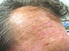 Actinic keratoses on the forehead of a male Actinic keratoses on forehead.JPG