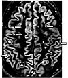 Axial DIR MRI of a brain with multiple sclerosis lesions.jpg
