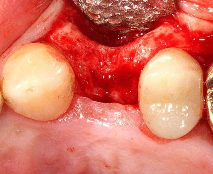 File:Basicimplant ridge.jpg