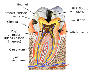 Tooth decay Blausen 0864 ToothDecay.svg