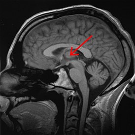 Таламус человека на МРТ-снимке, отмечен стрелкой