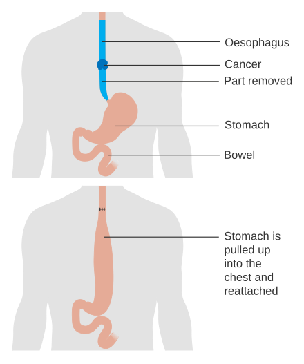 Esophageal Cancer Wikiwand