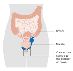 Stage 4A vaginal cancer