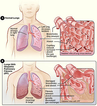 <span class="mw-page-title-main">Idiopathic pulmonary fibrosis</span> Medical condition