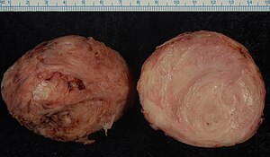 Uterine Fibroid