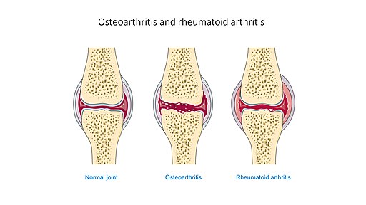 Osteoarthritis and rheumatoid arthritis - Normal joint Osteoarthr -- Smart-Servier