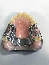 Palatal bar.jpg