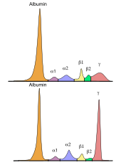 Monoklonale Gammopathie