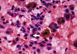 Thyroid cytopathology of Bethesda category V with nuclear groove.jpg