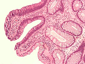 Tubuláris adenoma mikrocsúszása, jóindulatú növedékek láthatók